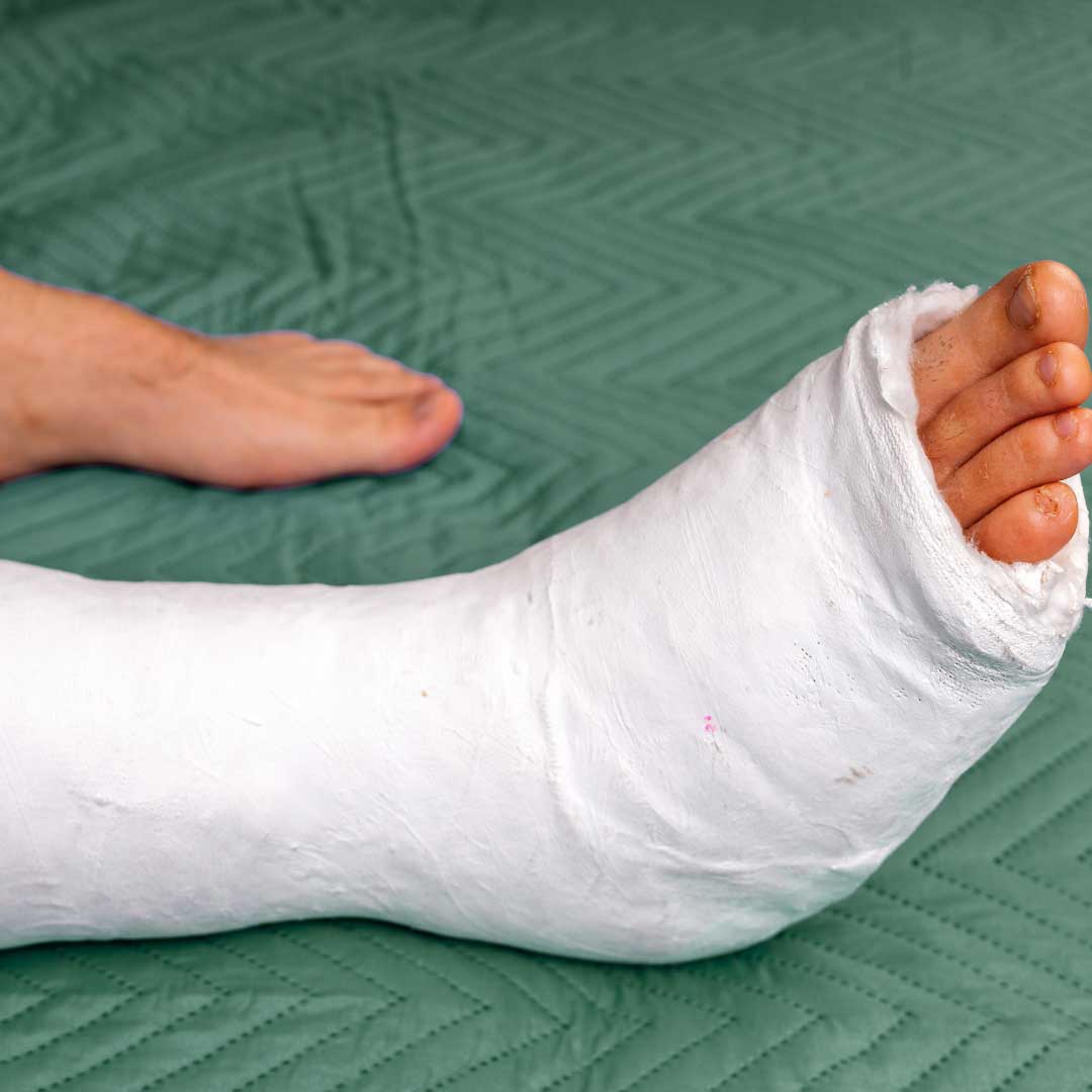 Imobilização e gesso